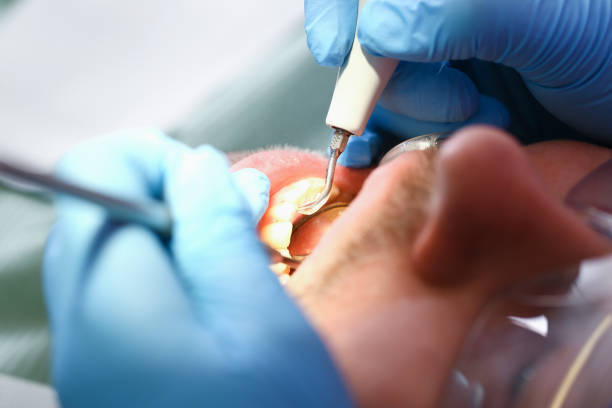 Best Emergency Treatment for Dental Infections or Abscesses in The Villages, FL